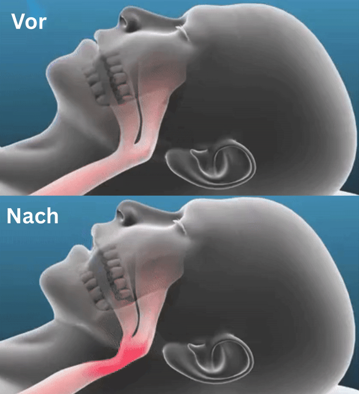 SnoreShield™ - Aufbissschiene